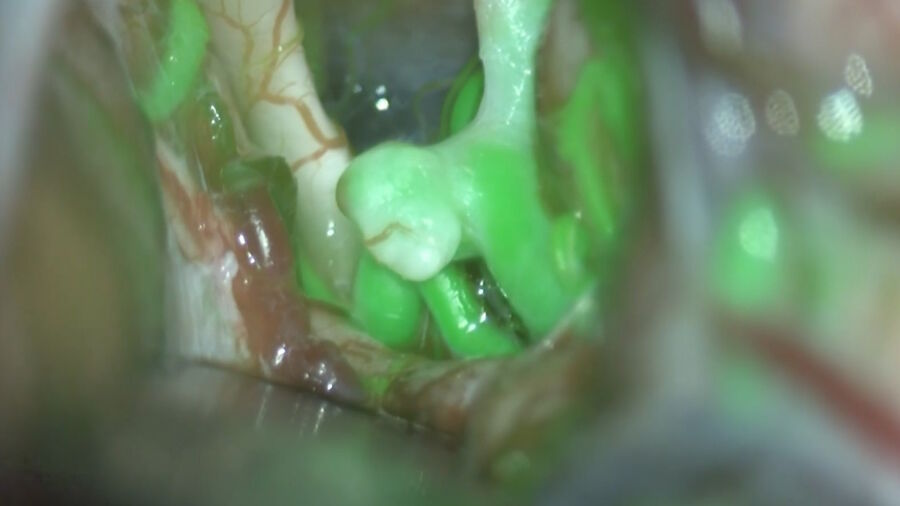Aneurysm clipping leveraging GLOW800. Image courtesy of Dr. Christof Renner.
