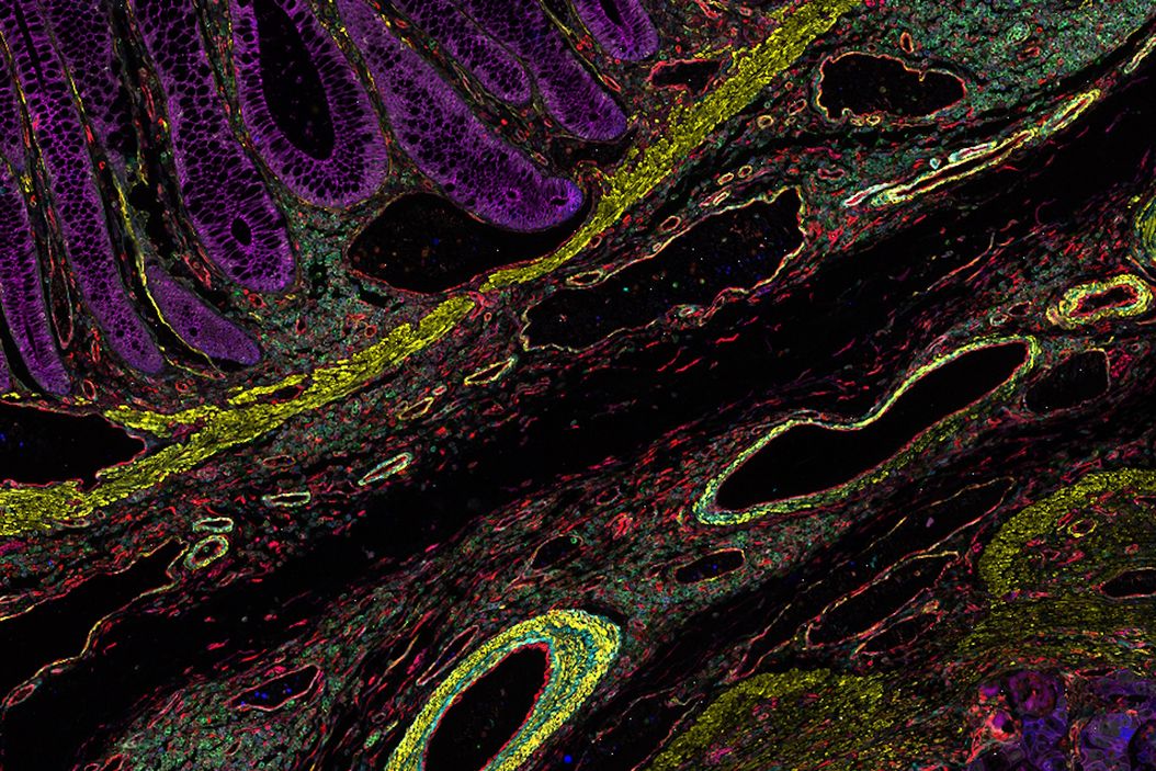 Colon adenocarcinoma and normal colon at the tumor margin. 13 biomarkers shown including Cadherin, CD3, CD4, CD8, CD20, CD31, CD45, Collagen, Caspase 9, BCL2, Beta-Catenin, Vimentin, and Smooth Muscle Actin. Colon_Adenocarcinoma_and_Normal_Colon_13_Markers.jpg