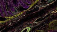 Colon adenocarcinoma and normal colon at the tumor margin. 13 biomarkers shown including Cadherin, CD3, CD4, CD8, CD20, CD31, CD45, Collagen, Caspase 9, BCL2, Beta-Catenin, Vimentin, and Smooth Muscle Actin.