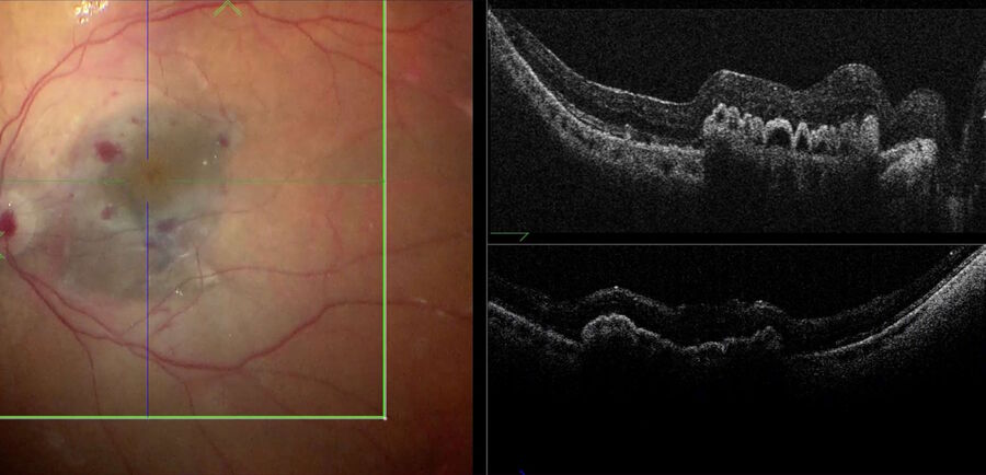 [Translate to chinese:] Intraoperative OCT view of a choroidal transplant well positioned under the fovea.