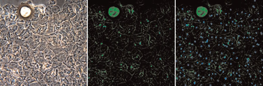 Fig. 2: SPERM HY-LITER™ staining of a sexual assault smear slide performed by a forensic DNA crime laboratory. The smear slide was stained according to the SPERM HY-LITER™ supplied protocol. Photomicrographs taken with PAX-IT 2 camera using DAPI, FITC and dual DAPI/FITC cubes. Note that there is an air bubble at the top of the image.