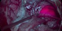 Neuro-Oncology