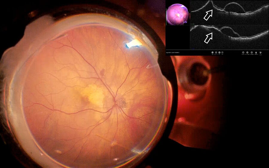 Fig. 11: Iatrogenic choroidal detachment visualized using OCT (depicted by white arrows). The cannula was then removed and a choroidal misdirection of TPA was avoided thanks to the EnFocus intraoperative OCT visualization.