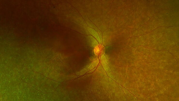 Diffuse retinal degeneration with relative macular sparing.