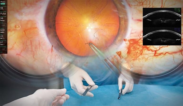 MyVeo view in ophthalmology with real-time EnFocus intraoperative OCT imaging and phaco data overlay.