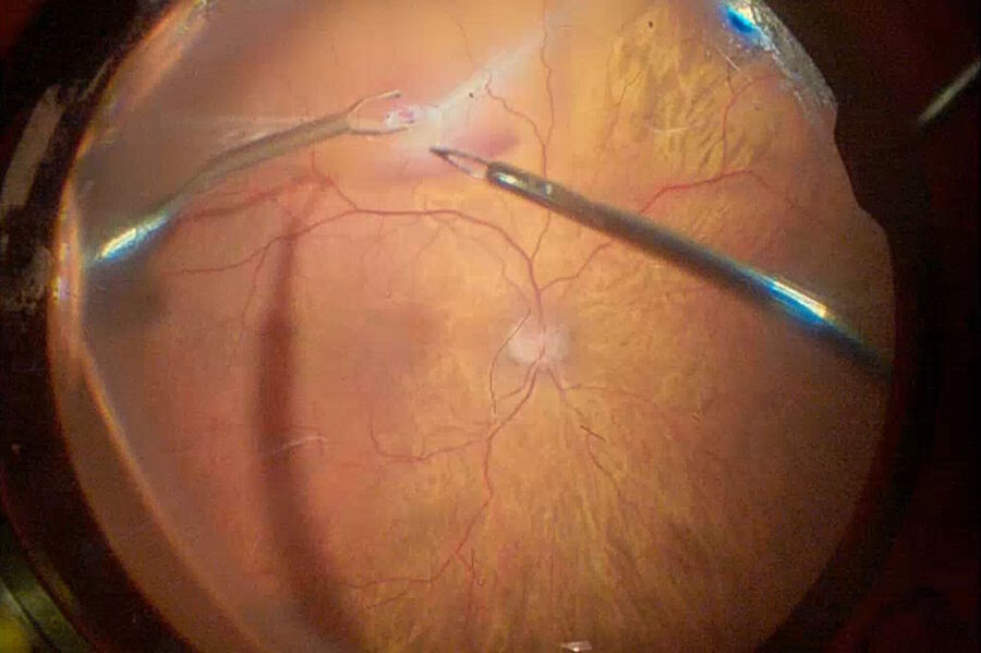 Fig. 7: An endodiathermy probe was used for retinotomy and subretinal fibrosis was removed with 23-gauge forceps placed above the macular hole.