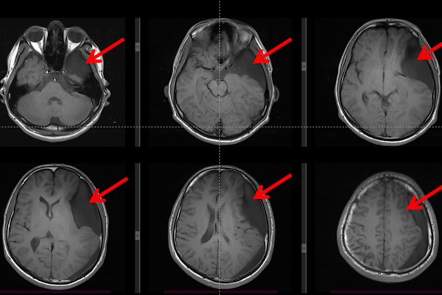 T1 weighted brain MRI showing a large arachnoid cyst (represented by red arrows with a hypo-signal compared to the rest of the brain and iso-signal when compared to the cerebrospinal fluid inside the ventricles)