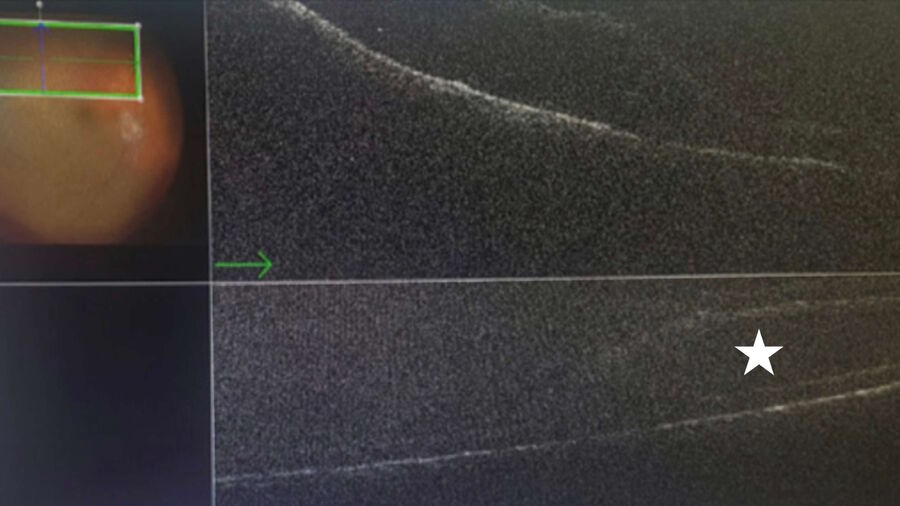 Intraoperative OCT view confirming that a suspect retinal detachment is, in fact, an area of retinoschisis (represented by the asterisk).