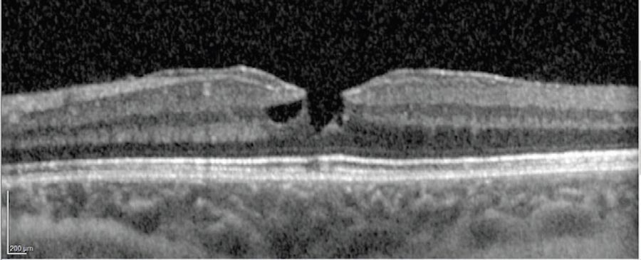 Pre-Operative scan showing lamellar macular hole.