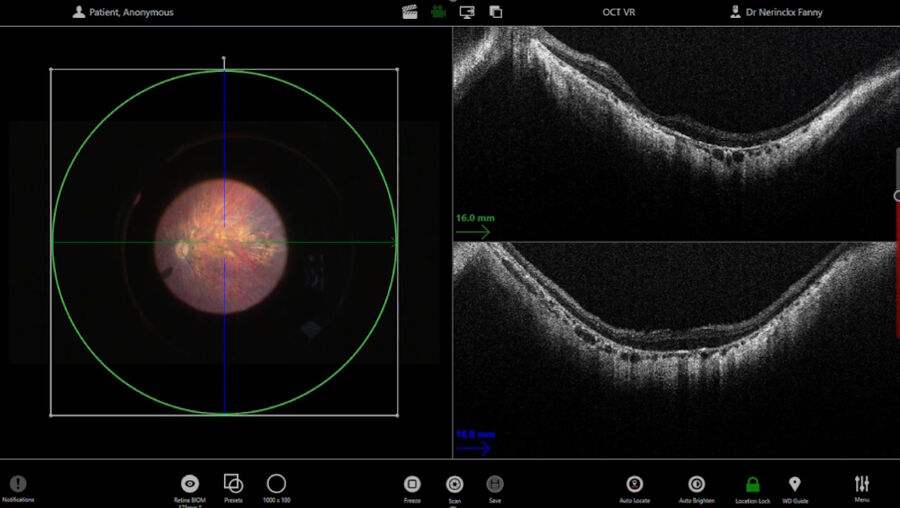 Figure 2: Check for posterior vitreous detachment with intraoperative OCT.