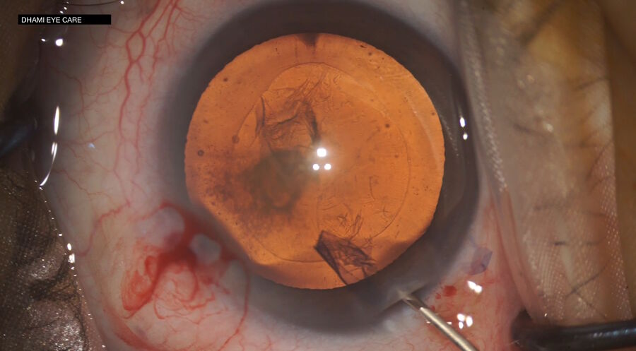 Figure 1: A stable red reflex enables a clear view of micro-anatomical details. Image courtesy of Dr. Abhinav Dhami.