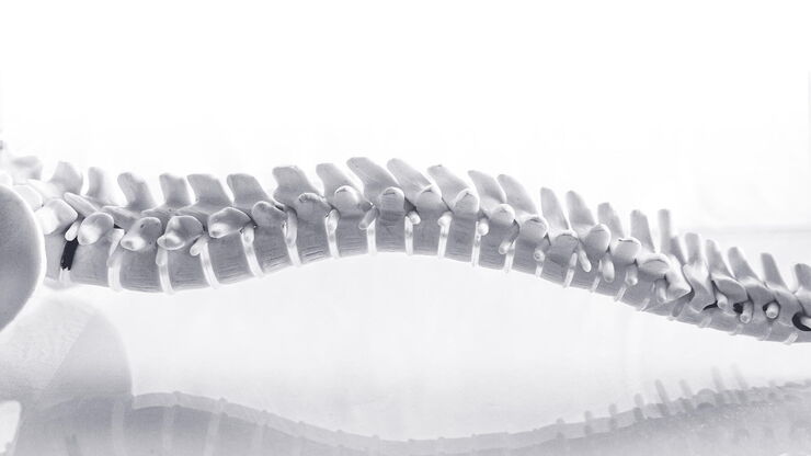 Spinal arterio-venous fistulas may require surgical treatment. Picture copyright: Cavan-Images, Shutterstock Spinal arterio-venous fistulas may require surgical treatment. Picture copyright: Cavan-Images, Shutterstock