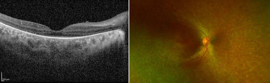 The macular OCT and ultra-wide field fundus images showed baseline pigmentary retinopathy and photoreceptor alterations relatively sparing the fovea. Images provided by Robert A. Sisk, MD, FACS.