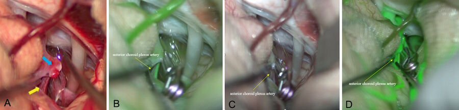 Fig. 1: ACha bifurcation aneurysm. A) Blue arrow: aneurysm, Yellow arrow: anterior choroid plexus artery. B) GLOW800 ICG visualization during initial clipping. Yellow arrow:  reduced blood flow is seen in one of the two anterior choroidal arteries. C) Clip re-position to restore blood flow. D) Checking vascularization after clip repositioning with  GLOW800: Restored blood flow can now be seen in the AChA