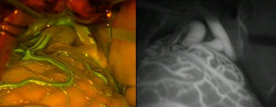 [Translate to chinese:] Visualization of an AVM with the Leica FL560 fluorescein fluorescence module vs visualization with ICG: