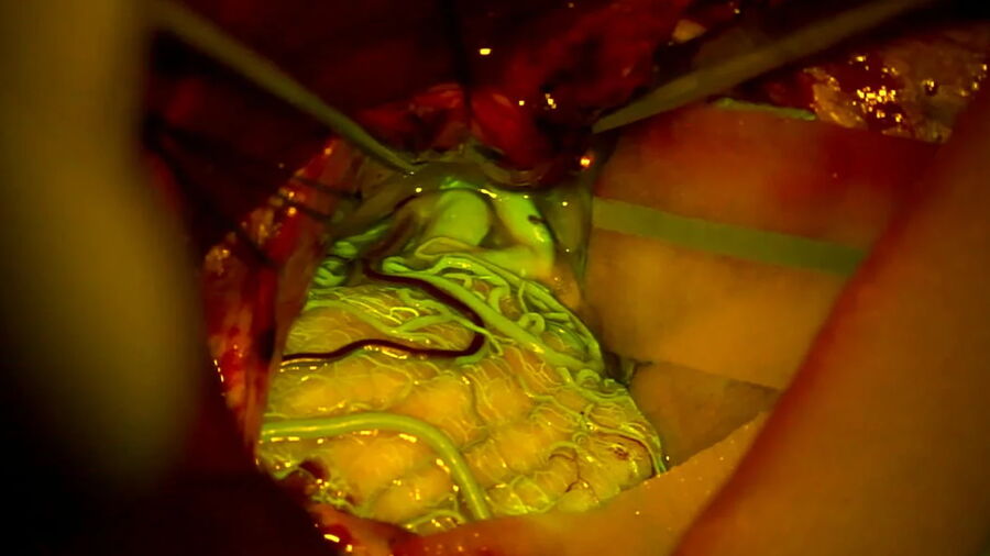 Aneurysm clipping leveraging the Leica FL560 fluorescein fluorescence module.