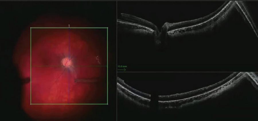 Hyaloid face elevated by aspiration from the optic disc. Intraoperative OCT assisted viewing where the hyaloid was still attached.