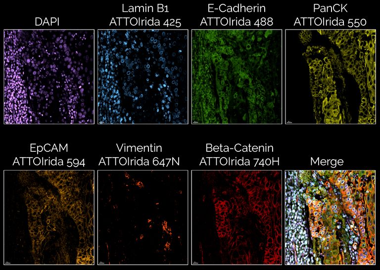 Human lung squamous cell carcinoma imaged with seven channels per cycle (six antibodies + DAPI).