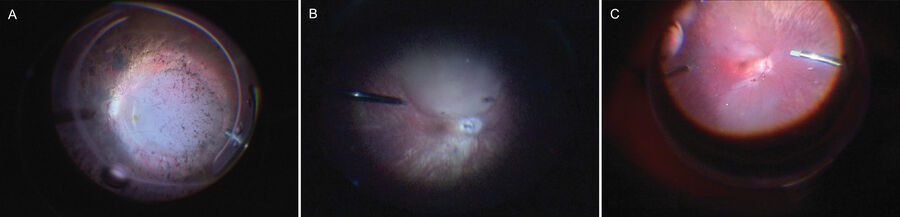 Figure 2: Examples of Gene Augmentation Therapy Blebs. A) Bullous foveal detachment, B) Fovea and Parafoveal detachment, C) Fovea sparing bilobed.