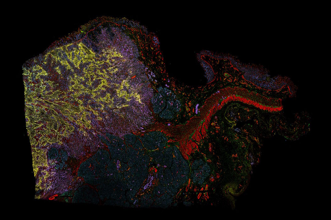 Pancreatic Ductal Adenocarcinoma with 5 biomarkers shown – SMA, PanCK PCK26, PanCK AE1, Vimentin, and Glut1. Pancreatic_Ductal_Adenocarcinoma_with_5_biomarkers.jpg