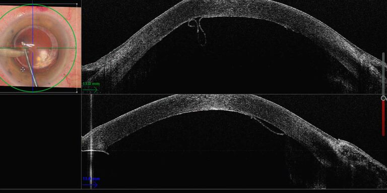 Dünne manuelle Descemet-Stripping-Endothel-Keratoplastik (TM-DSEK): Die intraoperative OCT zeigte deutlich das Peeling der Descemet-Membran und des Endothels. Bild mit freundlicher Genehmigung von Herrn David Anderson, MB BS FRCOphth PhD FEBO, University Hospital Southampton NHS FT, UK