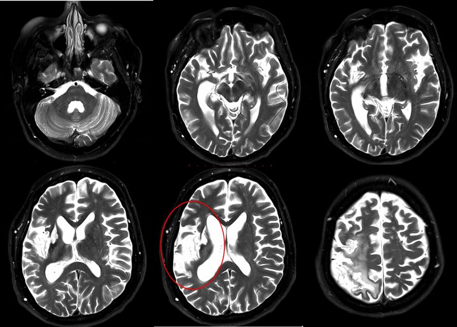T2-weighted brain MRI in the axial plane showing hyperintensity in the right MCA territory (red circle), consistent with ischemia.