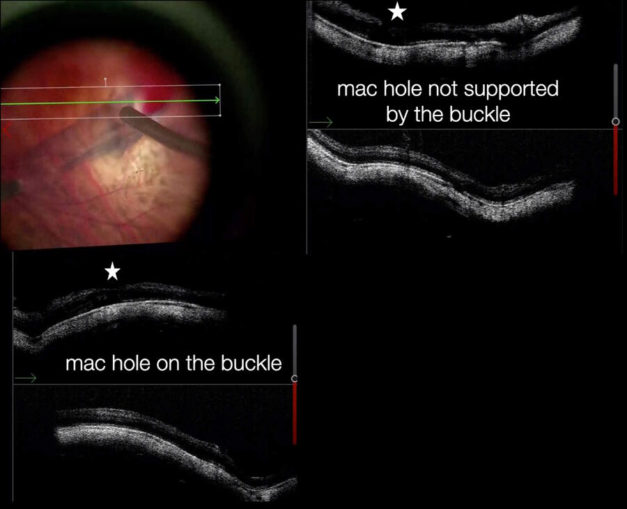 Intraoperative visualization provides a detailed confirmation of the buckle position and of the macular hole on the top right, which is NOT well positioned on the buckle