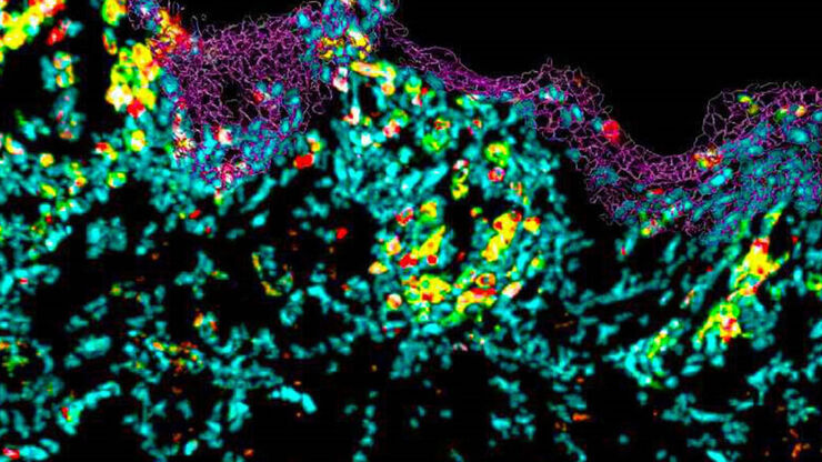 Multiplex image of Lupus erythematosus skin sample for lymphoid panel, staining CD45, CD3, CD4, CD8, TCRγδ, CD57 and CD20. Scholaert et al. 2023, Sci.Adv. 9