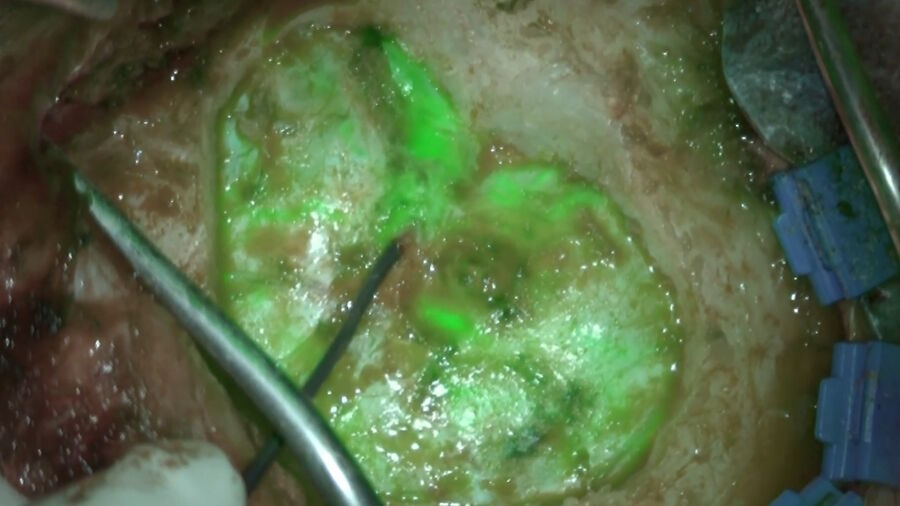 Cranial dural arterio-venous fistula treatment with GLOW800. Image courtesy of Dr. Christof Renner.