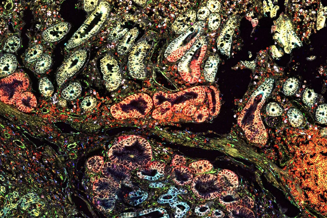 [Translate to chinese:] Pancreatic Ductal Adenocarcinoma with 11 Apoptosis biomarkers shown – BAK, BAX, BCL2, BCLXL, Caspase9, CIAP1, NaKATPase, PCK26, SMAC, Vimentin, and XIAP. Pancreatic_Ductal_Adenocarcinoma_11_Apoptosis_Markers_ROI5.jpg