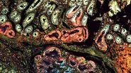 Pancreatic Ductal Adenocarcinoma with 11 Apoptosis biomarkers shown – BAK, BAX, BCL2, BCLXL, Caspase9, CIAP1, NaKATPase, PCK26, SMAC, Vimentin, and XIAP.