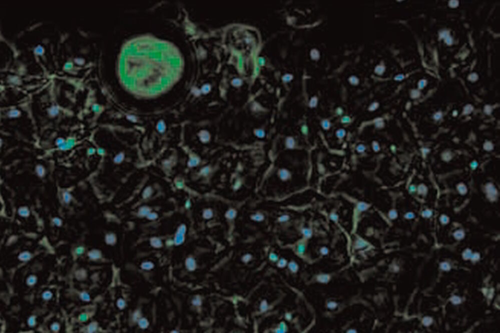 [Translate to chinese:] SPERM HY-LITER™ staining of a sexual assault smear slide performed by forensic DNA crime laboratory. SPERM_HY-LITER_staining_of_sexual_assault_smear_slide-dual_DAPI_FITC_cubes.jpg