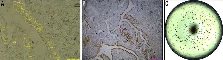 Fig. 2: Laser microdissection of fallopian tube epithelial cells: A) contour alignment with the LMD7 software before laser microdissection; B) screenshot taken after laser microdissection; and C) a 384-well inspection after laser microdissection of individual cells.