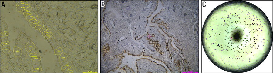 [Translate to chinese:] A) Contour alignment in the LMD7 software before laser microdissection of fallopian tube epithelial cells. B) Screenshot after laser microdissection. C) 384-well inspection after laser microdissection in individual fallopian tube epithelial cells.