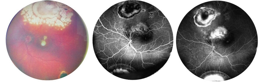 患者曾患有视网膜母细胞瘤。图片由 Nikolaos Bechrakis 教授提供。