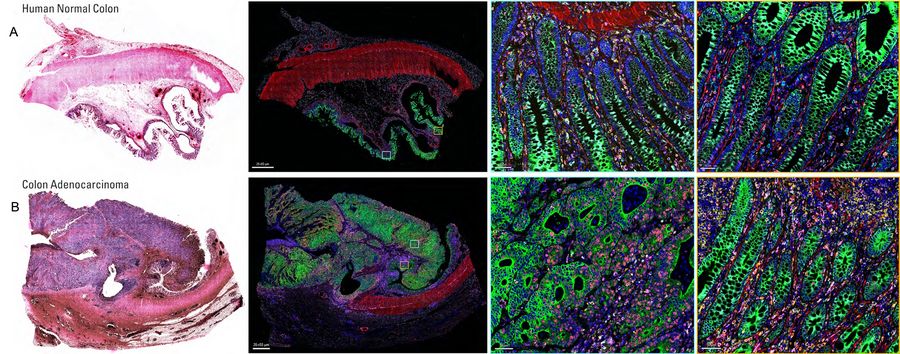 Cell DIVE multiplexed imaging of normal colon and colon adenocarcinoma tissues. Cell DIVE multiplexed imaging of normal colon and colon adenocarcinoma.