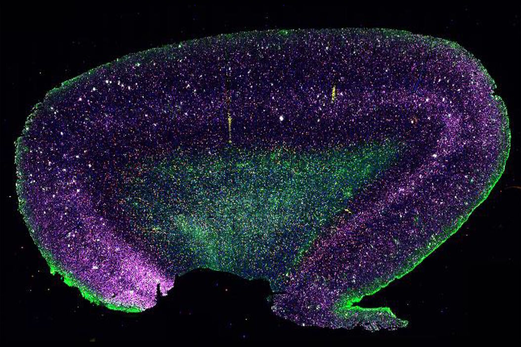 [Translate to chinese:] Adult human Alzheimer’s brain demonstrating a panel of 15 markers. Adult_human_Alzheimers_brain.jpg