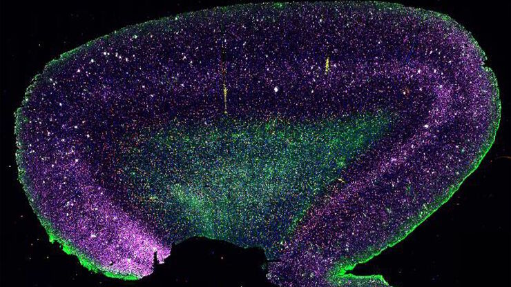 [Translate to chinese:] Adult human Alzheimer’s brain demonstrating a panel of 15 markers.