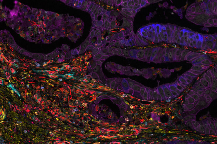 Colon adenocarcinoma with 13 biomarkers shown