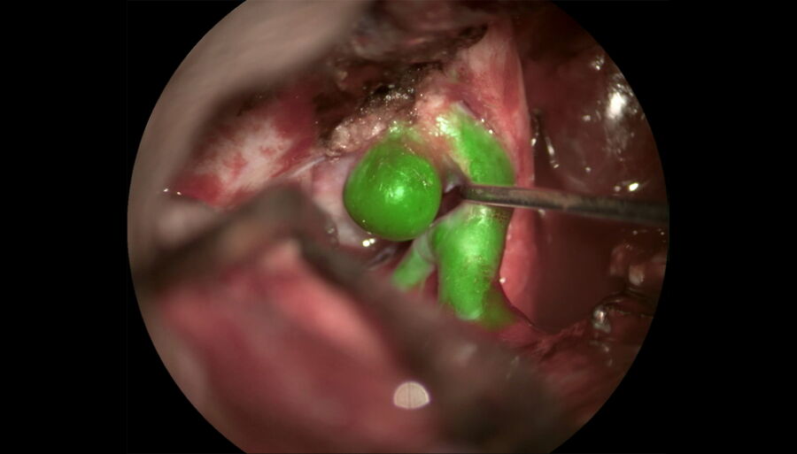 Intracranial aneurysm, GLOW800