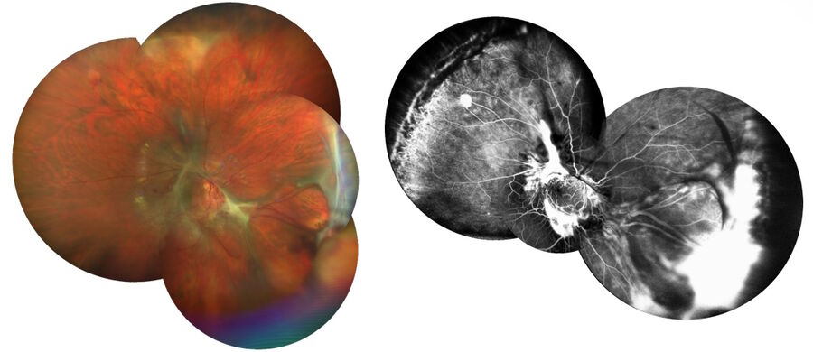 术前图像。患者有多个血管母细胞瘤，其中一个非常大。图片由 Nikolaos Bechrakis 教授提供。