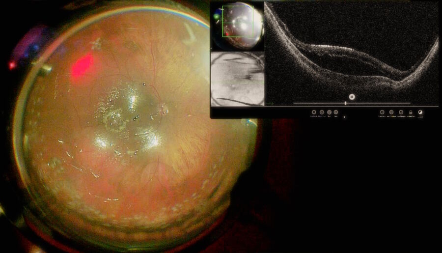 Fig. 17: Rhegmatogenous retinal detachment with retinal macroaneurysm. After the fluid-air exchange, it was possible to observe remaining subretinal fluid on the macular area using EnFocus intraoperative OCT. Moreover, the OCT image was produced despite the cavity being filled with air.