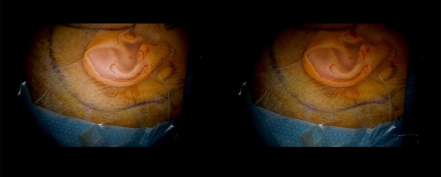 Combined petrosectomy 3D educational video. Image courtesy of Dr. Florian Bernard.