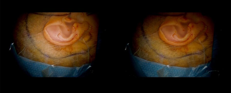 Combined petrosectomy 3D educational video. Image courtesy of Dr. Florian Bernard.