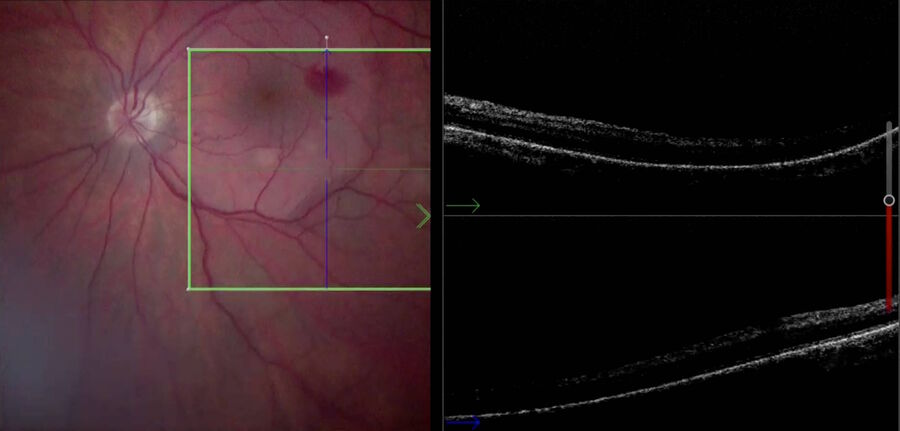 [Translate to chinese:] Bleeding spot created during peeling of the epiretinal membrane.