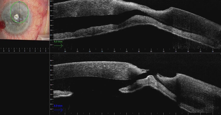 The intraoperative OCT allowed to assess the extent of the corneal perforation, which was very deep. Images provided by Mr. David Anderson The intraoperative OCT allowed to assess the extent of the corneal perforation, which was very deep. Images provided by Mr. David Anderson