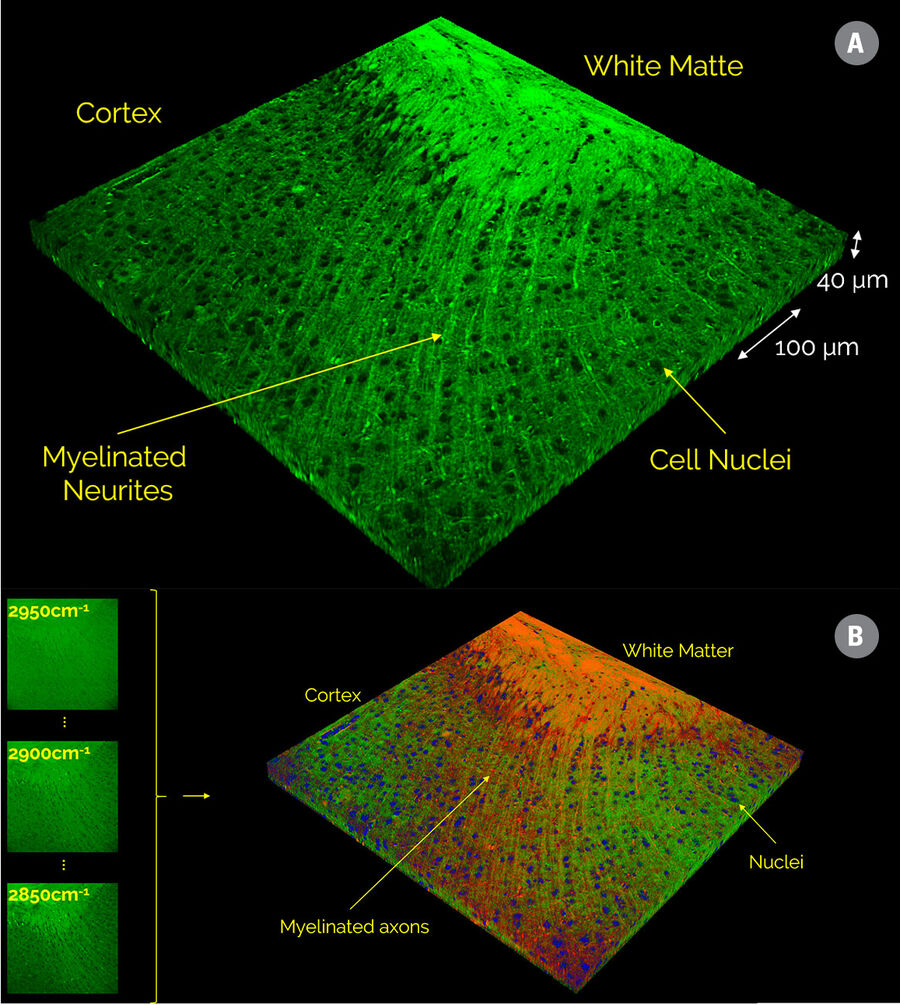 Figure 5: Illustration of Automatic Dye Separation with a small SRS image stack. (A) SRS image of a region of brain tissue at the junction between gray and white matter featuring myelinated axons that merge into white-matter-bundles in the back of the image, as well as neuronal cell bodies and nuclei. (B) Representative spectral images and unmixing result, showing clean separation into lipid-rich and protein-rich structures and cell nuclei (red, green, and blue, respectively).