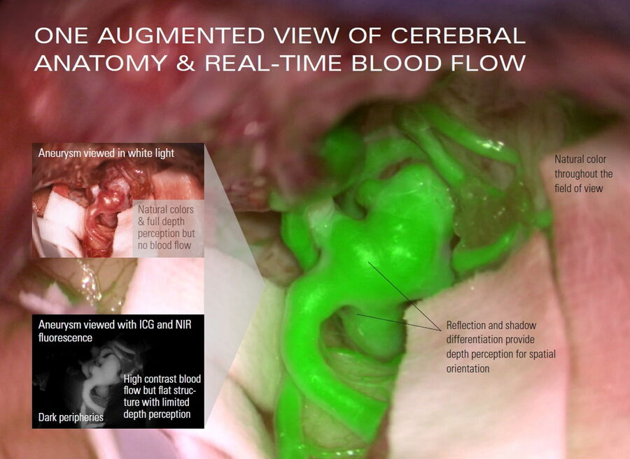 Aneurysm viewed with ICG and GLOW800 AR Fluorescence.