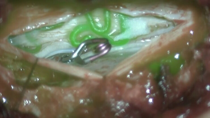 Augmented Reality fluorescence supports each step of neurovascular surgery procedures. Image courtesy of Dr. Christof Renner.