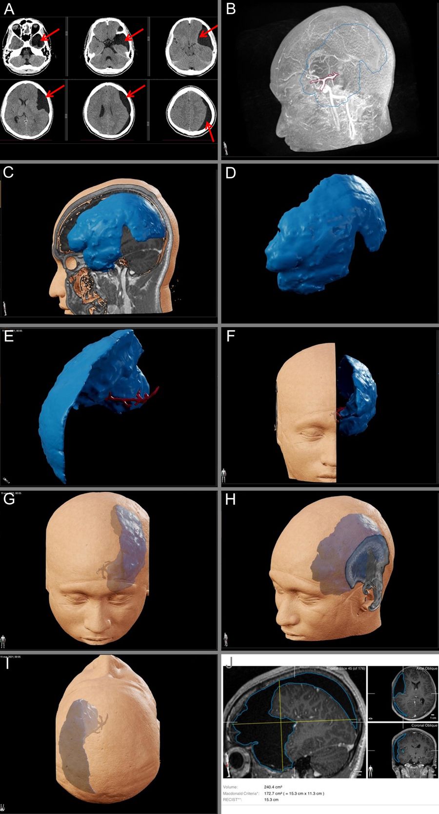 Volumetric Magnetic Resonance Imaging Reconstruction